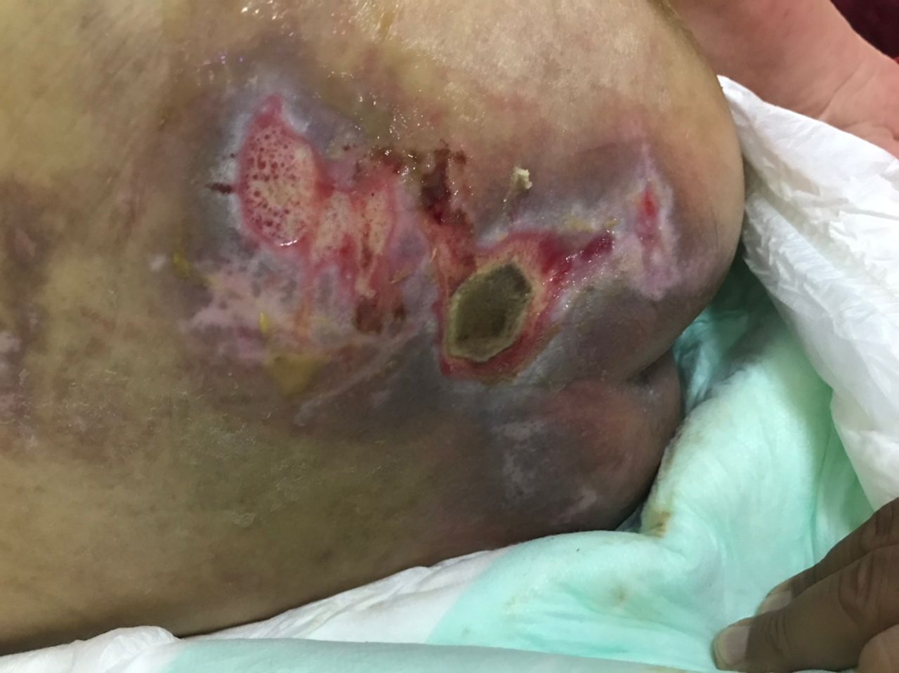 Doctor dressing for wound at home